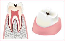 虫歯の原因
