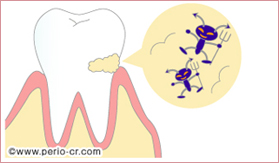 歯周病とは