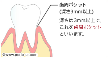 歯周病の歯