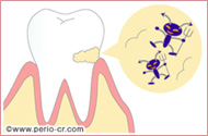 歯周病治療